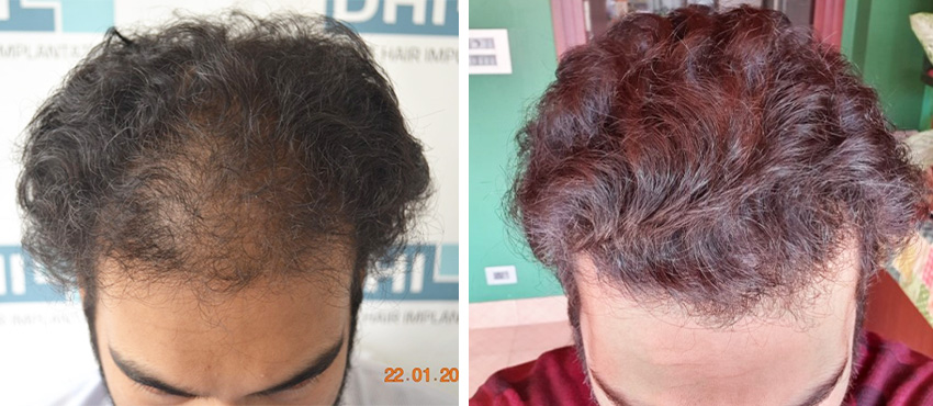 DHI before & after hair transplant results